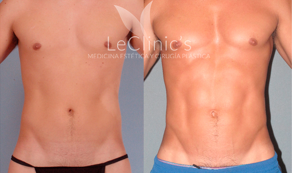 Marcacion abdominal antes y despues mujeres