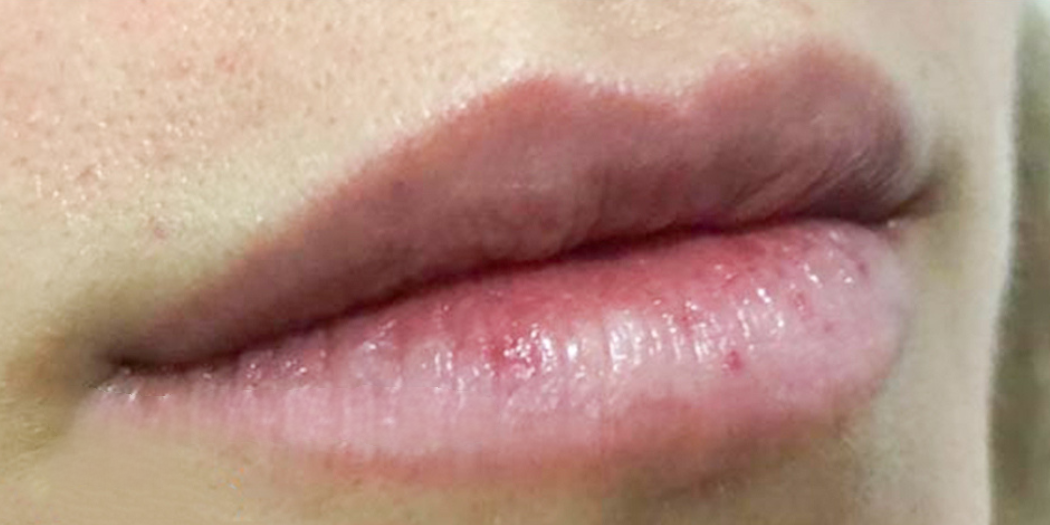 Aumento de labios antes