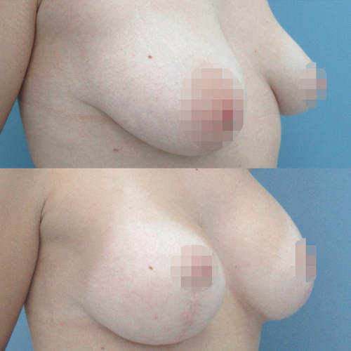 correcion de mamas tuberosas en madrid