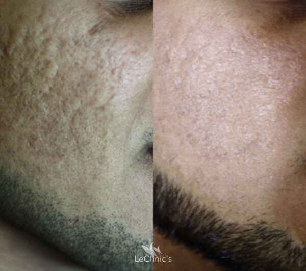 Marcas y cicatrices causadas por el acné