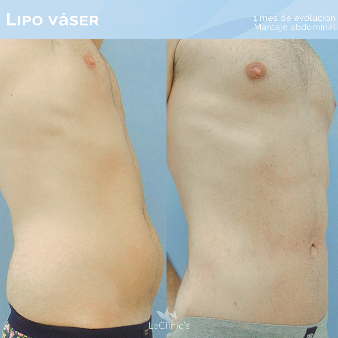 Marcación abdominal con Lipo Vaser