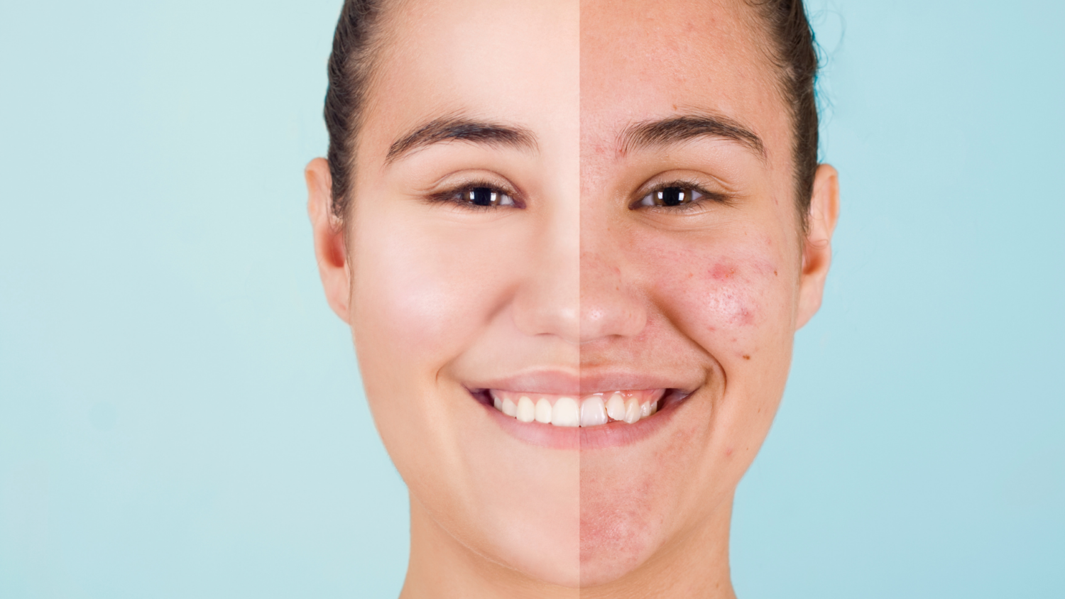 Cómo acabar con el acné: Trucos y tratamientos para combatirlo