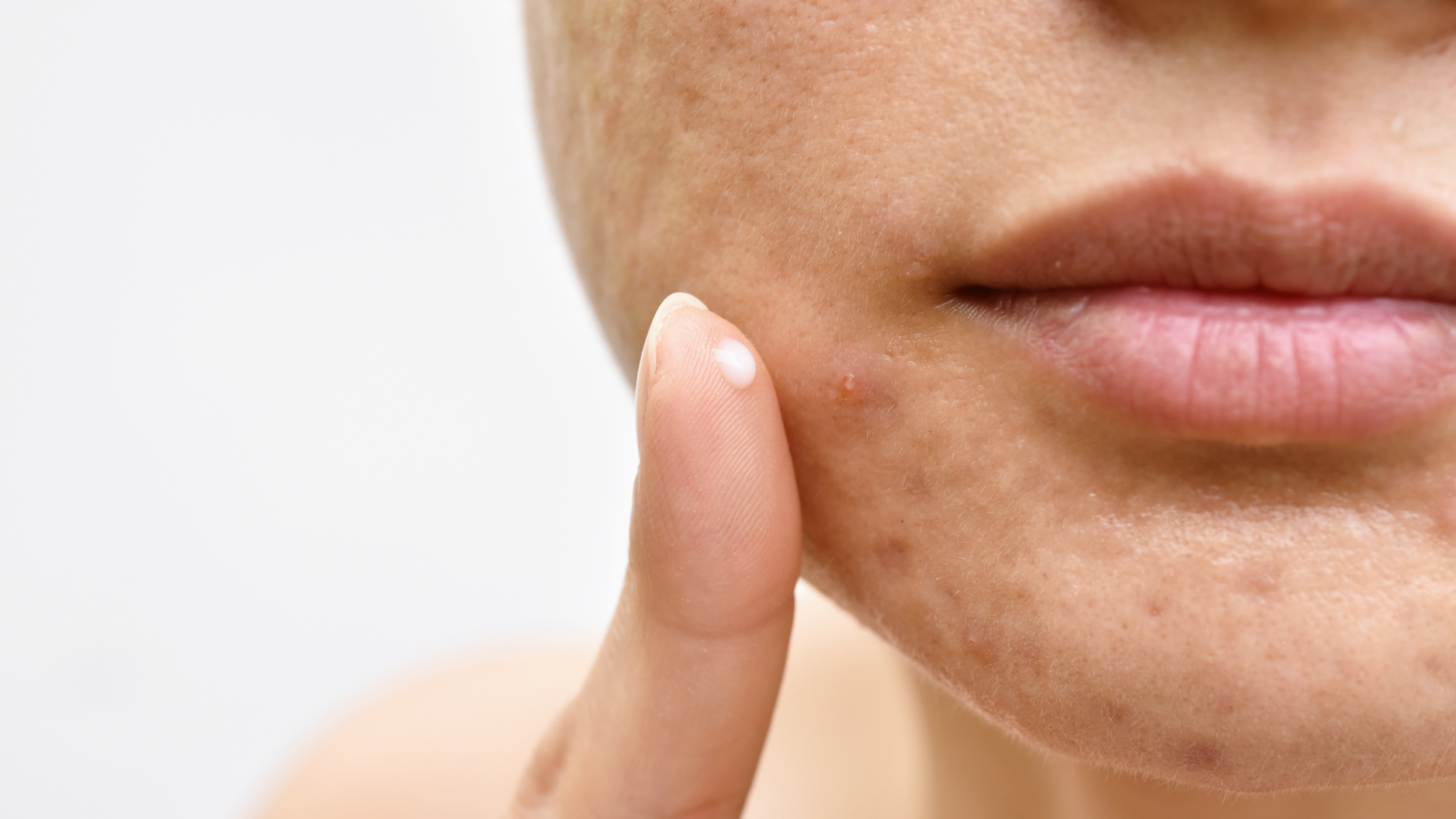 Cómo acabar con el acné: Trucos y tratamientos para combatirlo