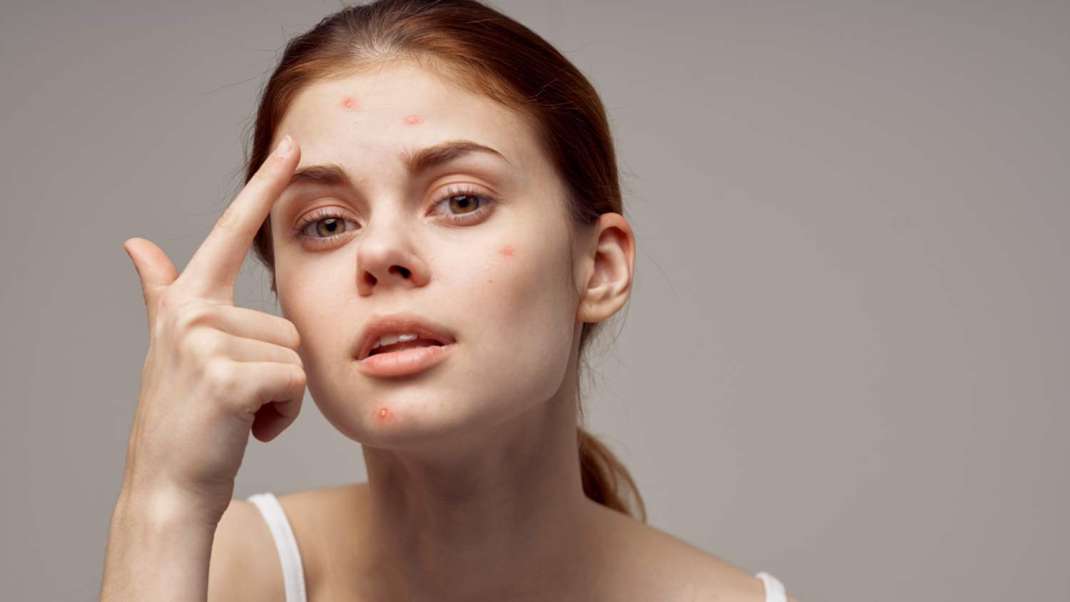 Cómo eliminar las marcas del acné
