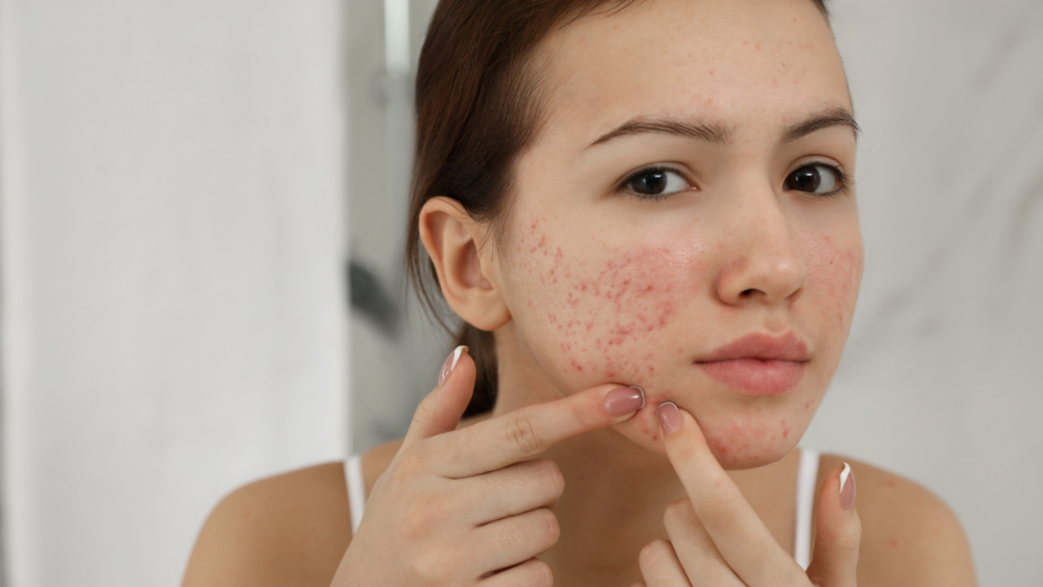 eliminar marcas de acne