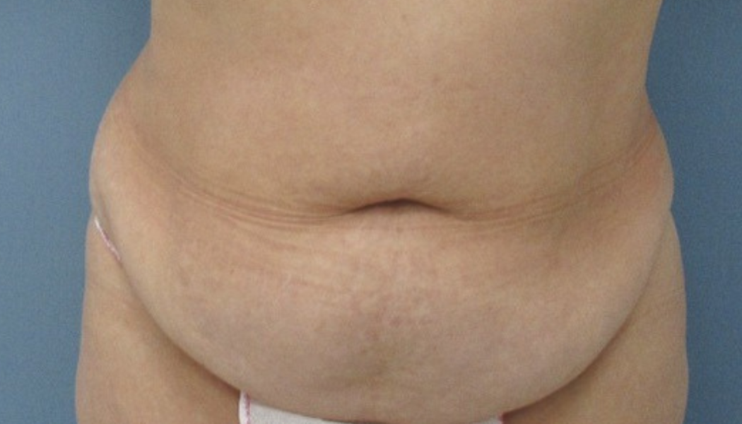 Abdominoplastia-antes