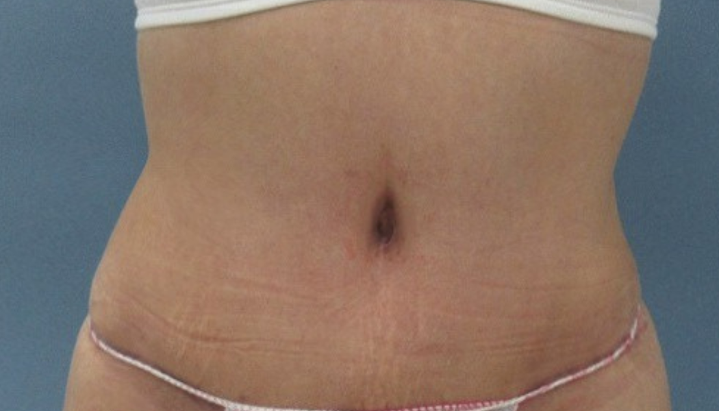 Abdominoplastia-despues
