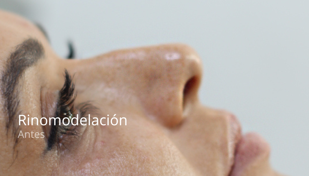 imgi_36_rino-antes