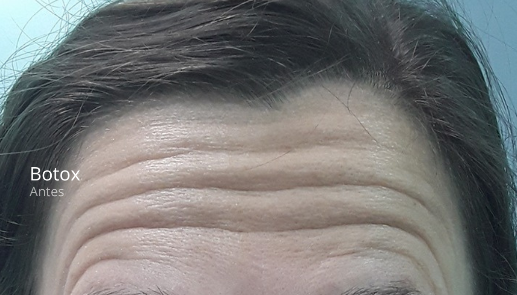 imgi_38_Botox-antes-2