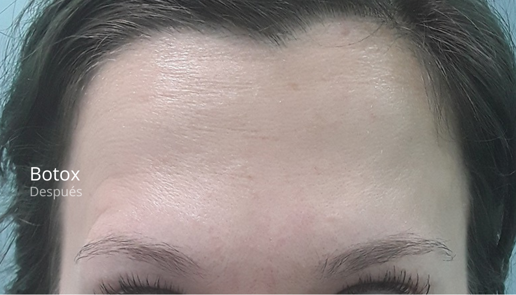 imgi_39_Botox-despues-3