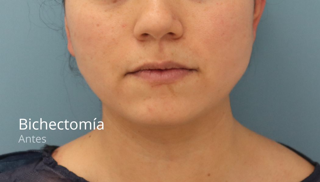 imgi_42_Bichectomia-antes-2-2