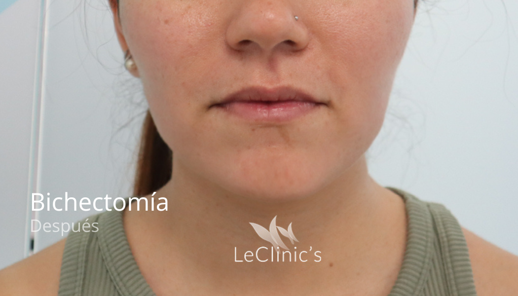 imgi_43_Bichectomia-antes-4