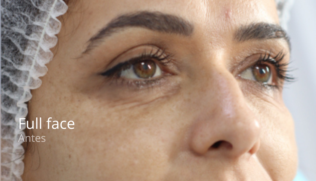 imgi_44_Full-face-antes-2