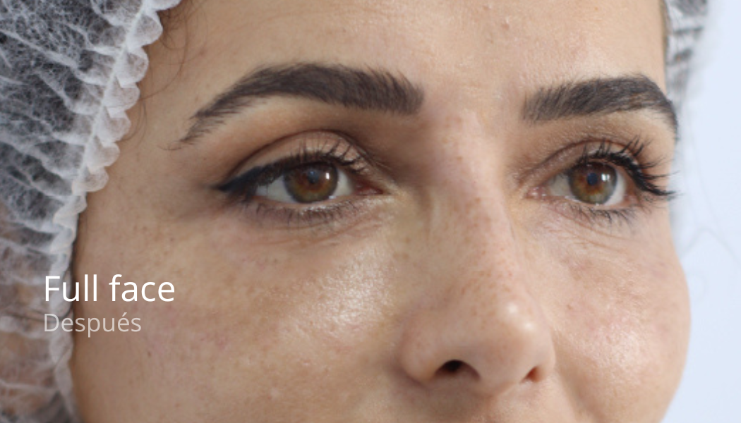 imgi_45_Full-face-despues-3