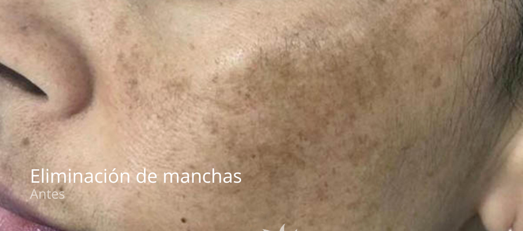 imgi_46_manchas-antes-1-e1679402496534