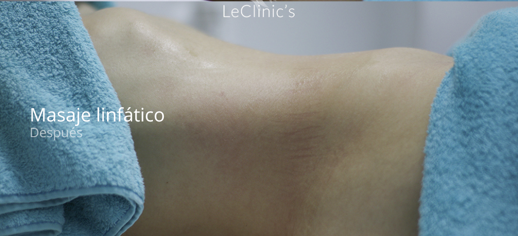 imgi_51_masaje-linfatico-despues-e1679402916972