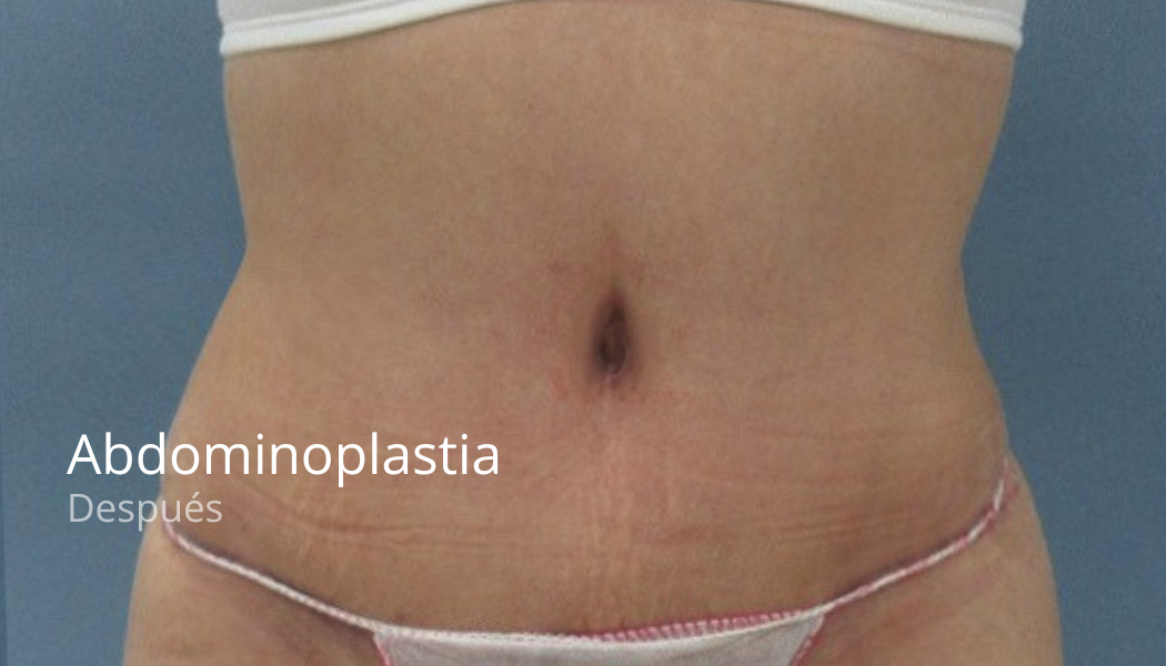 imgi_53_Abdominoplastia-despues-3