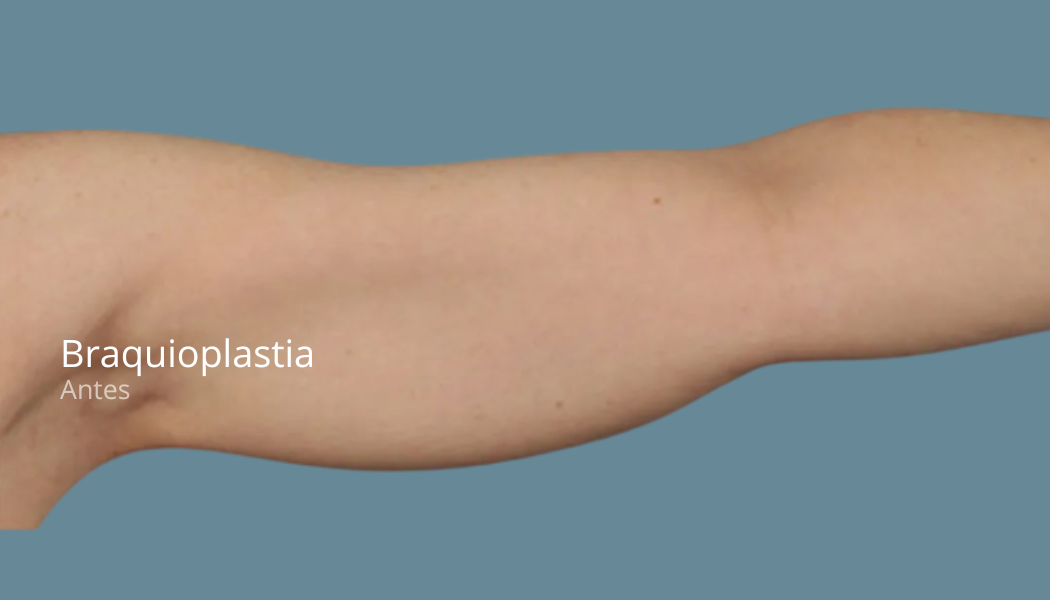 imgi_56_branquioplastia-antes-1