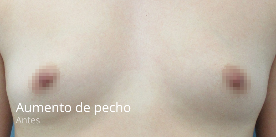 imgi_60_Aumento-de-pecho-antes-3-e1679403156961