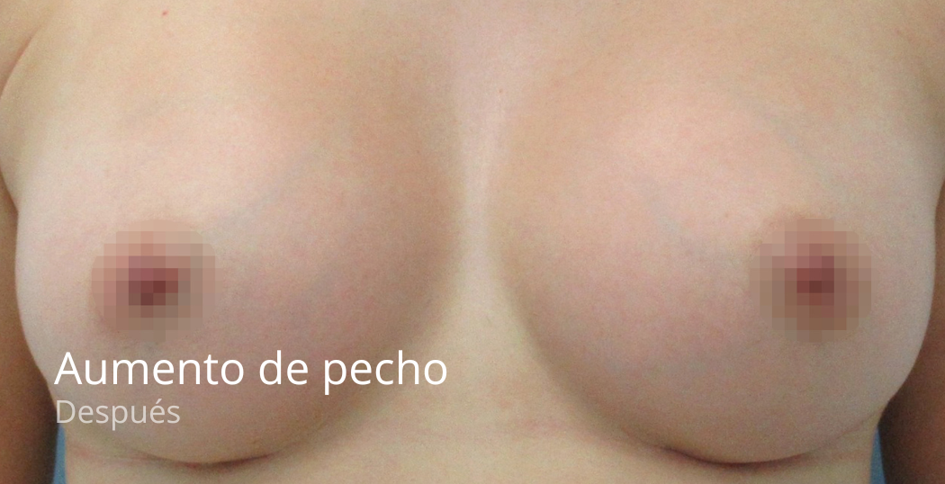 imgi_61_Aumento-de-pecho-despues-5-e1679403192977