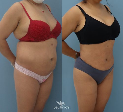 Lipo vaser con lipotransferencia