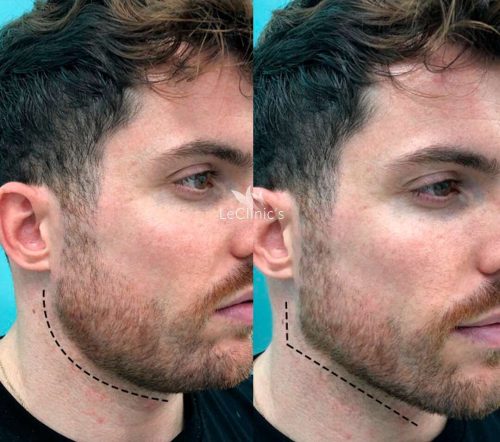 masculinizacion facial antes y despues